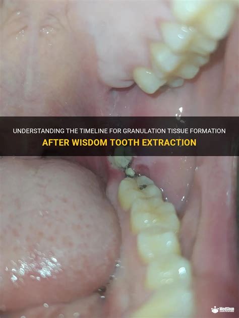 Understanding The Timeline For Granulation Tissue Formation After Wisdom Tooth Extraction | MedShun