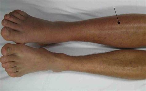 Calf tears - swelling and DVT | RunningPhysio