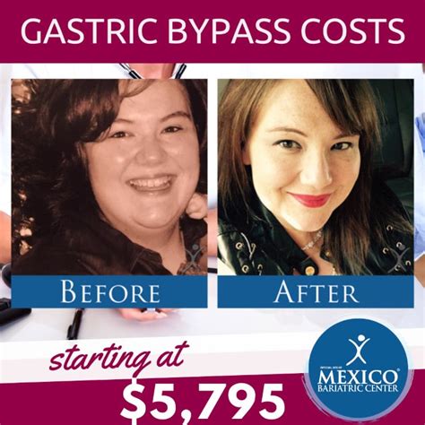 Gastric Bypass Surgery Costs - Worldwide Price Comparison