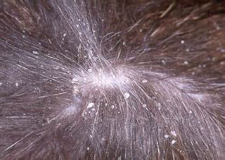 Dog Dandruff Causes, Pictures, Treatments, and Home Remedies