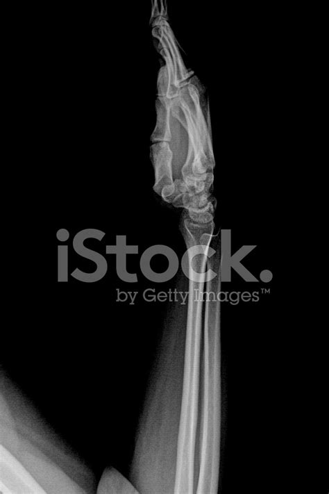 X Ray Image of Arm stock photos - FreeImages.com