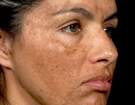 Melasma Treatment • Osman Dermatology