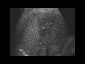 Abdomen and retroperitoneum | 1.1 Liver : Case 1.1.11 Fatty liver and focal sparing | Ultrasound ...