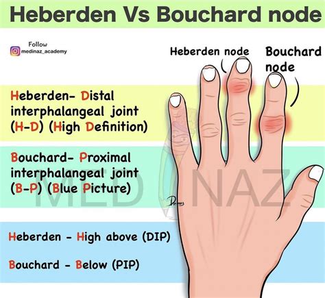 Osteoarthritis Nodes - Heberden & Bouchard Nodes