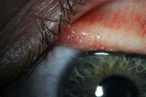 Report: Parasitic worms found in woman’s eye in California | Tdnews