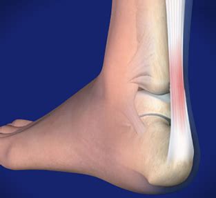 Achilles Tendon Lengthening - Newburyport, MA - Orthopedic Surgery