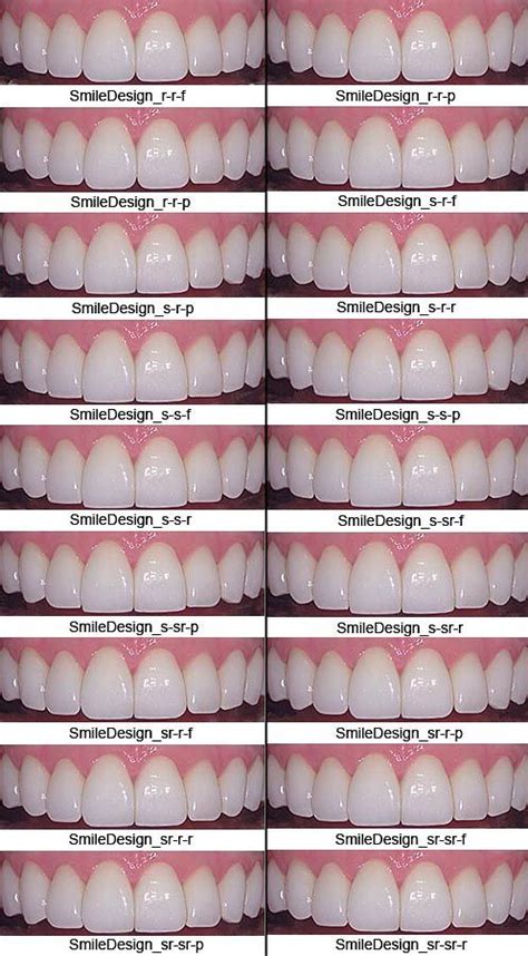 denture teeth color chart - Kendall Yarbrough