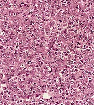 Nasopharyngeal carcinoma - Libre Pathology