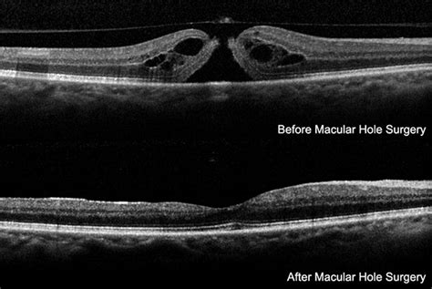 Macular Hole Surgery - Vitreous Retina Macula Consultants of New York