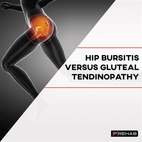 Hip Bursitis Versus Gluteal Tendinopathy - [P]rehab