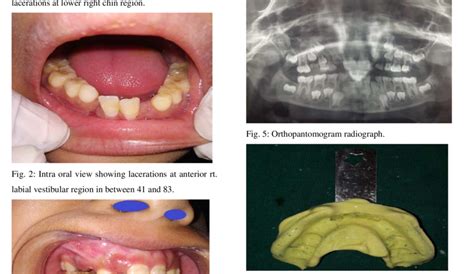 Patient's alginate impression. | Download Scientific Diagram