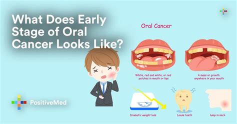 What Do Early Stages of Oral Cancer Look Like? - PositiveMed