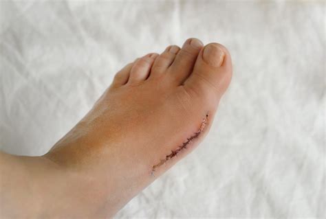 Why Could Your Bunions Reoccur After Foot Surgery?