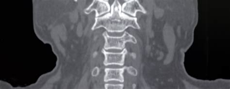 Cervical spine CT scan