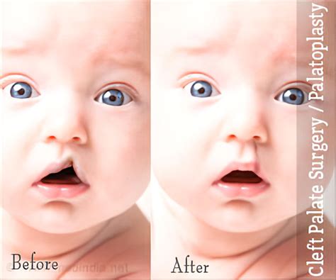 Cleft Palate Surgery | Palatoplasty - Procedure, Post-operative Care, Complications