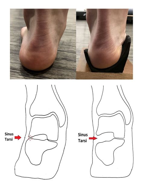 Sinus Tarsi Pain (Sinus Tarsi Syndrome) - Ankle, Foot and Orthotic Centre