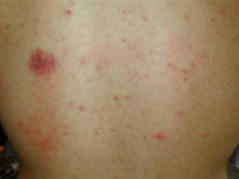 Medical Pictures Info – Heat Rash