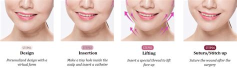 Thread Lifting Procedure - Complete Guide to Thread Face Lift - Seoul ...