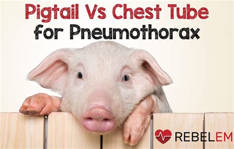 Pigtail Catheter vs Large Bore Chest Tube for Pneumothorax - REBEL EM - Emergency Medicine Blog