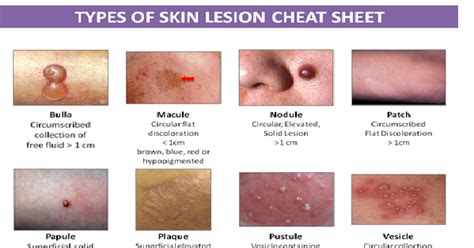 Types of Skin Lesion - StudyPK