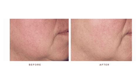 Laser Genesis Before and After Images | Infinity Skin Clinic