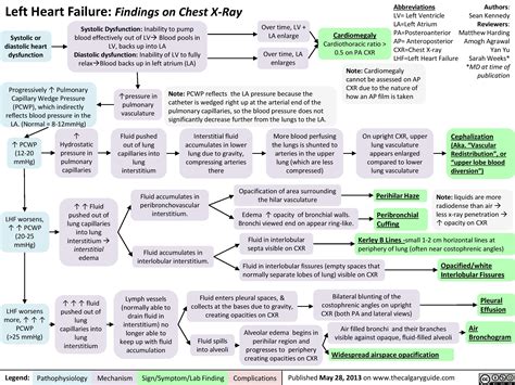 Left Heart Failure: Findings on Chest X-Ray | Calgary Guide