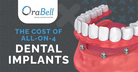 The Cost of All-on-4 Dental Implants | OraBell