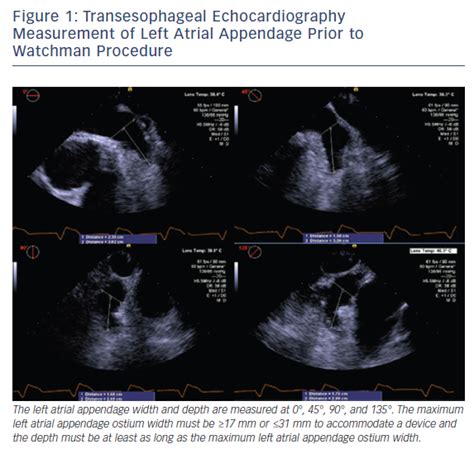 Figure 1: Transesophageal Echocardiography Measurement of Left Atrial ...