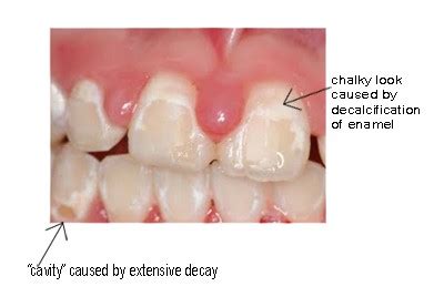 Tooth Remineralization Protocol - Cape Dental Care