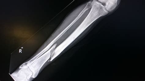 Tibia and Fibula Fractures - JOI Jacksonville Orthopaedic Institute