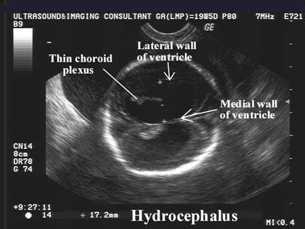 Fetal Hydrocephalus Ultrasound