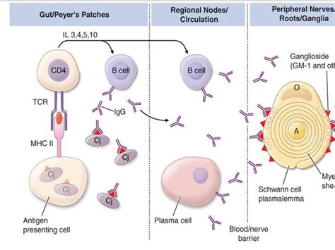 Gullian Barre Syndrome – Post-infectious demyelinating polyneuropathy ...