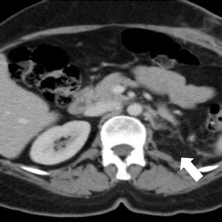 -Postoperative CT scan axial image showing left nephrectomy with ...