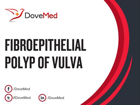 Fibroepithelial Polyp of Vulva