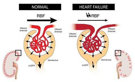 Tweet: renal sodium avidity in #HeartFailure Do you ever wonder what is ...