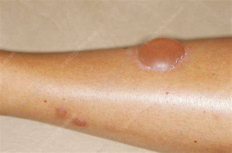 Allergic Reaction to Mosquito Bite - Stock Image - M320/0480 - Science Photo Library