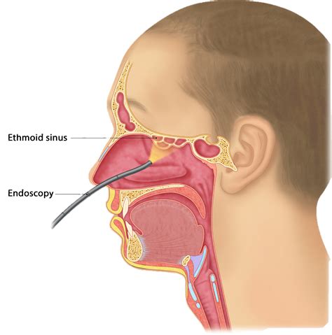 Nasendoscopy - Melbourne ENT Group (MEG)