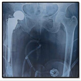 Postoperative X-ray of the hemiarthroplasty group. | Download ...