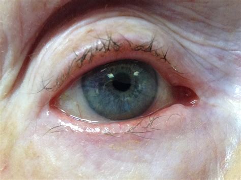 Blepharitis