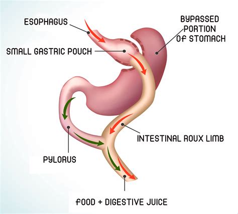 Roux En Y Gastric Bypass