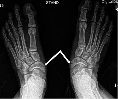 Navicular Subluxation