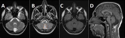 Mega Cisterna Magna Vs Arachnoid Cyst