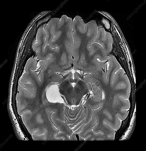 Hippocampal Choroidal Fissure Arachnoid Cyst - Stock Image - C043/2933 - Science Photo Library