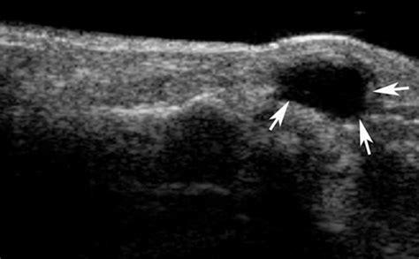 Peritonsillar Abscess Ultrasound