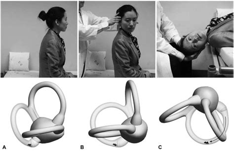 The Dix-Hallpike maneuver for benign paroxysmal positional vertigo... | Download Scientific Diagram