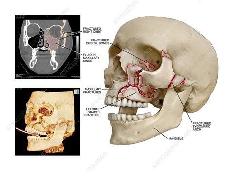 Multiple facial skull fractures - Stock Image - C021/0816 - Science Photo Library