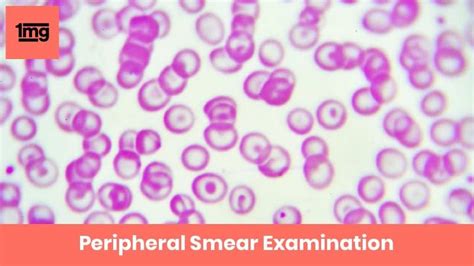 Peripheral Smear Examination (P/S): Purpose & Normal Range of Results | 1mg