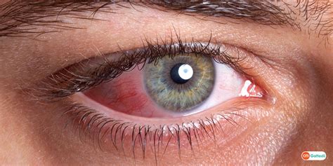 Retinal Hemorrhage : Know the Symptoms, Causes and Treatment- GoMedii