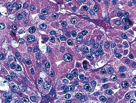 Pathology Outlines - Oncocytic (Hürthle cell) tumors