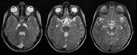 Dr Balaji Anvekar FRCR: Joubert syndrome MRI